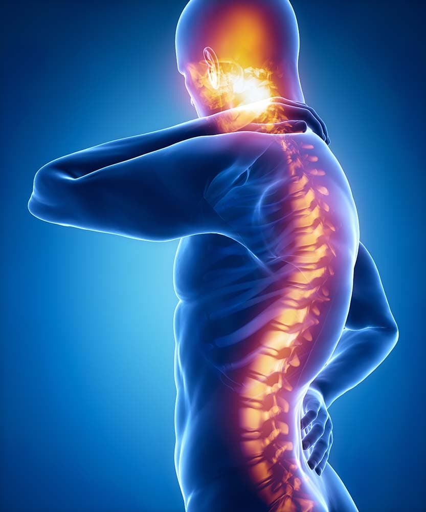 cervical radiculopathy on the body